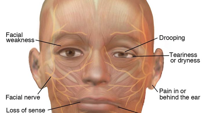 Facial Nerves Numbness 63